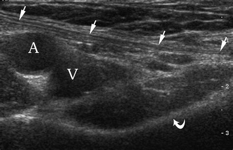 ultrasound of inguinal area